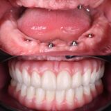 Dental Impant Example 3