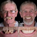 Dental Implant Example 1