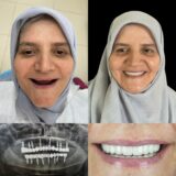 Dental Implant Example 2