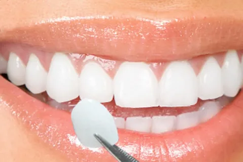 Side Dental Porcelain Laminate Veneer